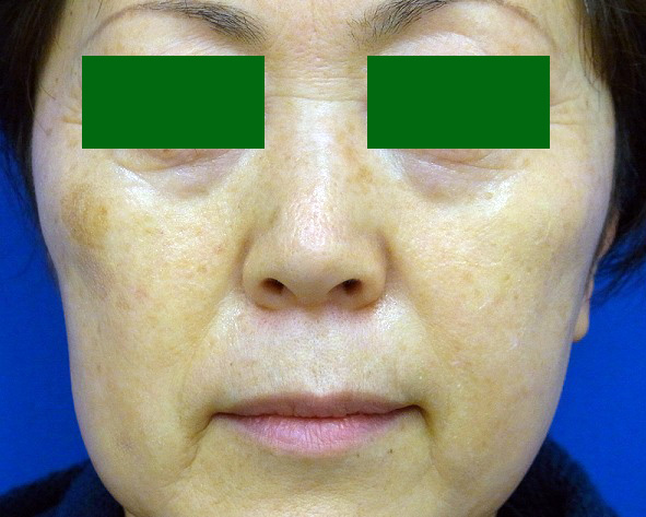 ヒアルロン酸注入 神谷町皮フ科形成外科 港区 神谷町の美容外科 一般皮膚科