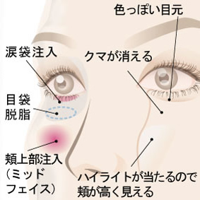 ヒアルロン酸注入　神谷町皮フ科形成外科