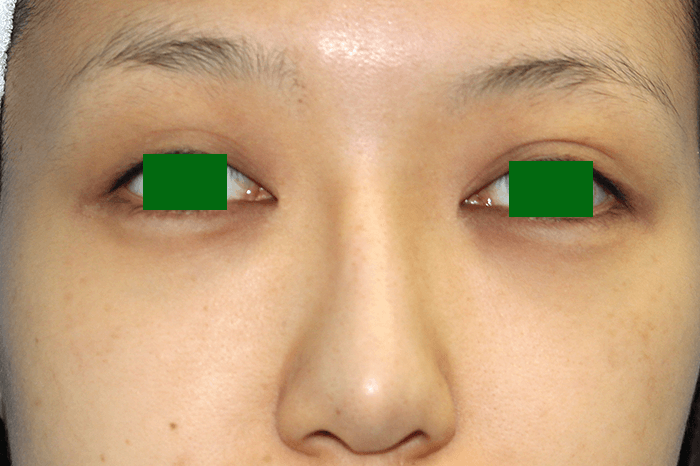 眉間プロテーゼ 神谷町皮フ科形成外科 港区 神谷町の美容外科 一般皮膚科