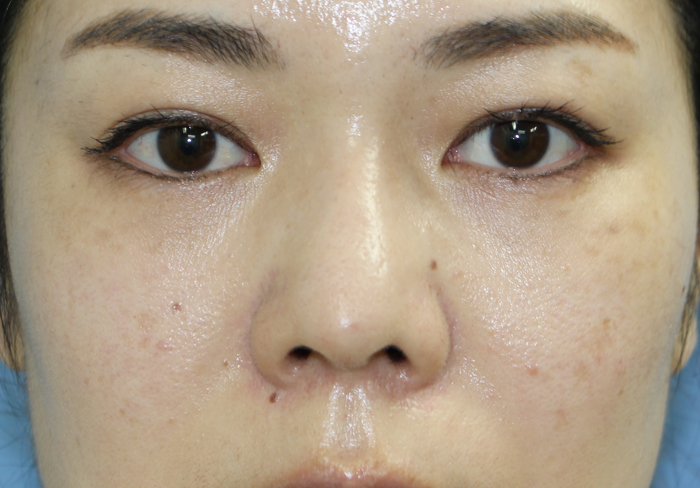 眉間プロテーゼ 神谷町皮フ科形成外科 港区 神谷町の美容外科 一般皮膚科