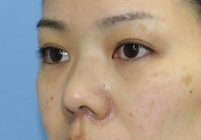 眉間プロテーゼ 神谷町皮フ科形成外科 港区 神谷町の美容外科 一般皮膚科