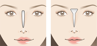 眉間プロテーゼ 神谷町皮フ科形成外科 港区 神谷町の美容外科 一般皮膚科